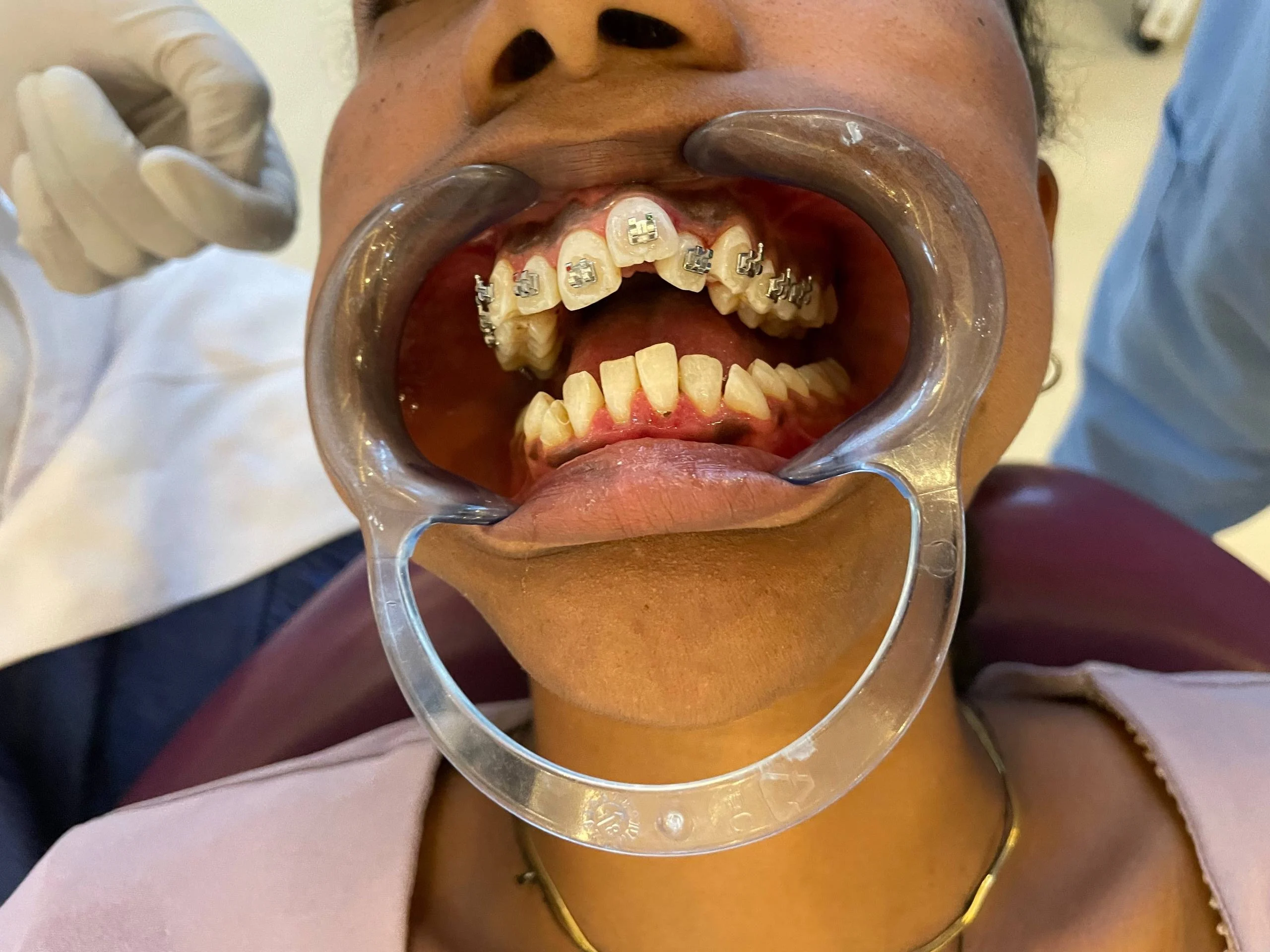 Braces treatment, After