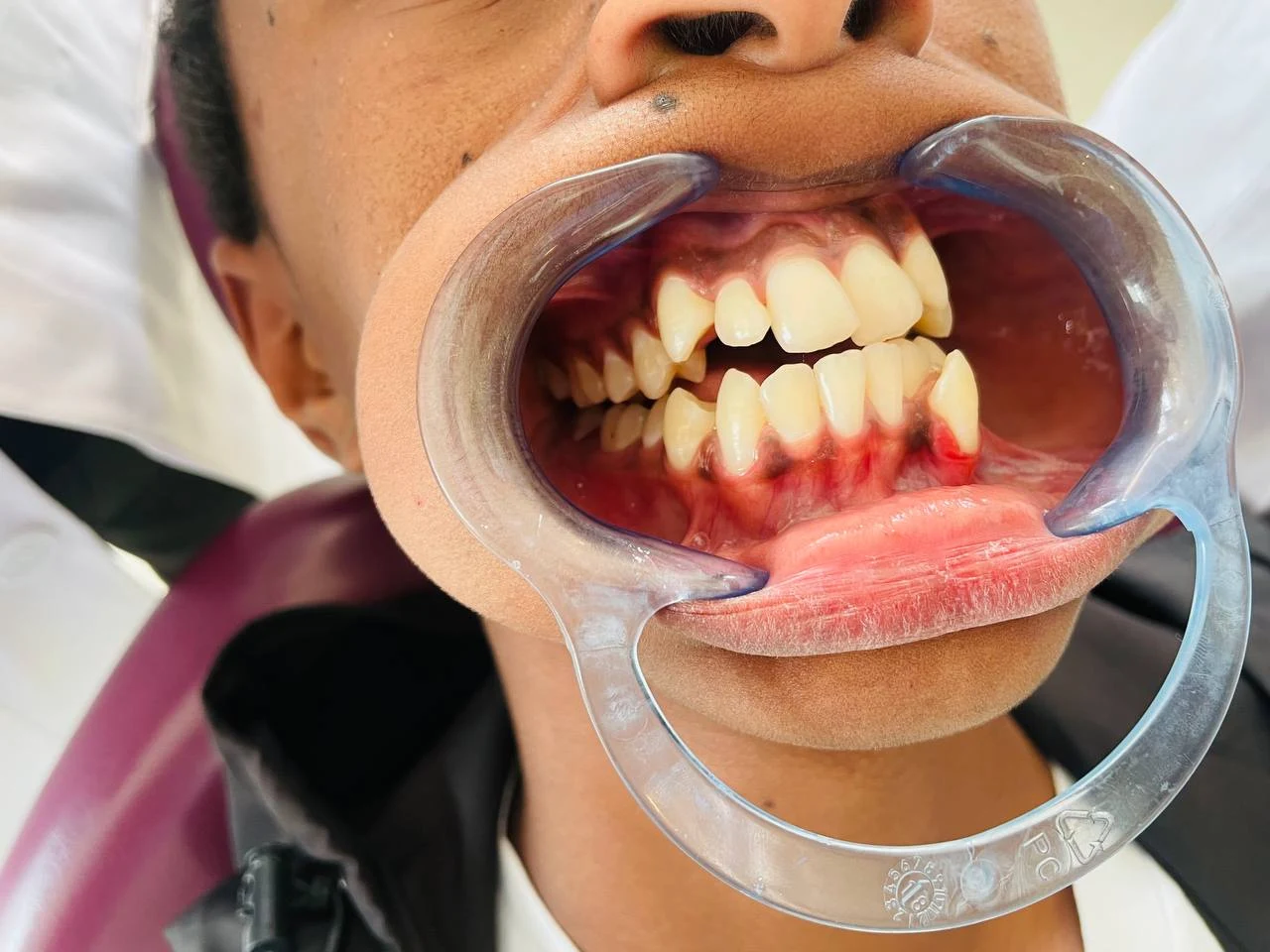 Braces treatment, Before