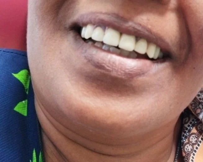 Flexible denture with anterior ceramic, After