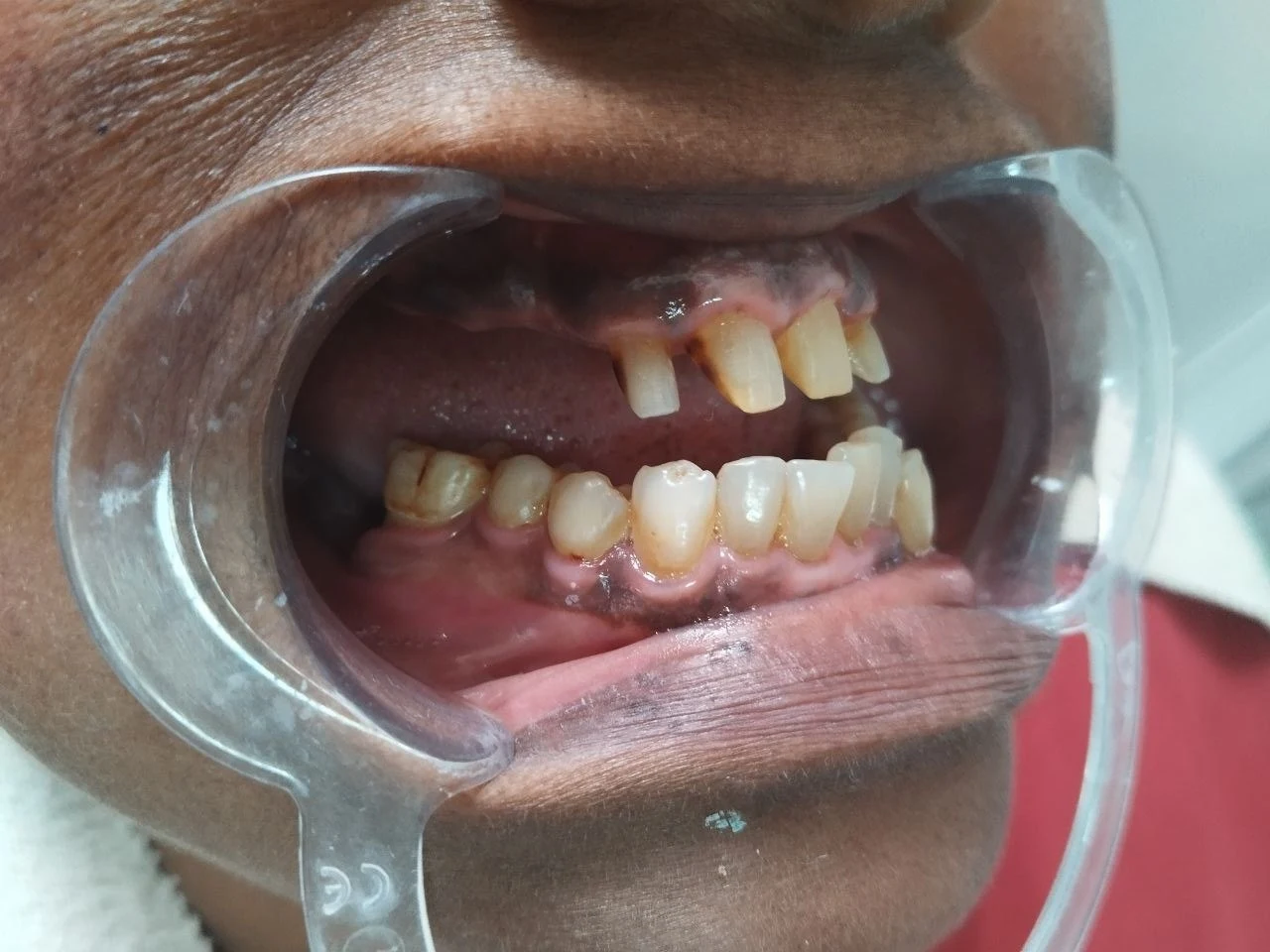 Flexible denture with anterior ceramic, Before