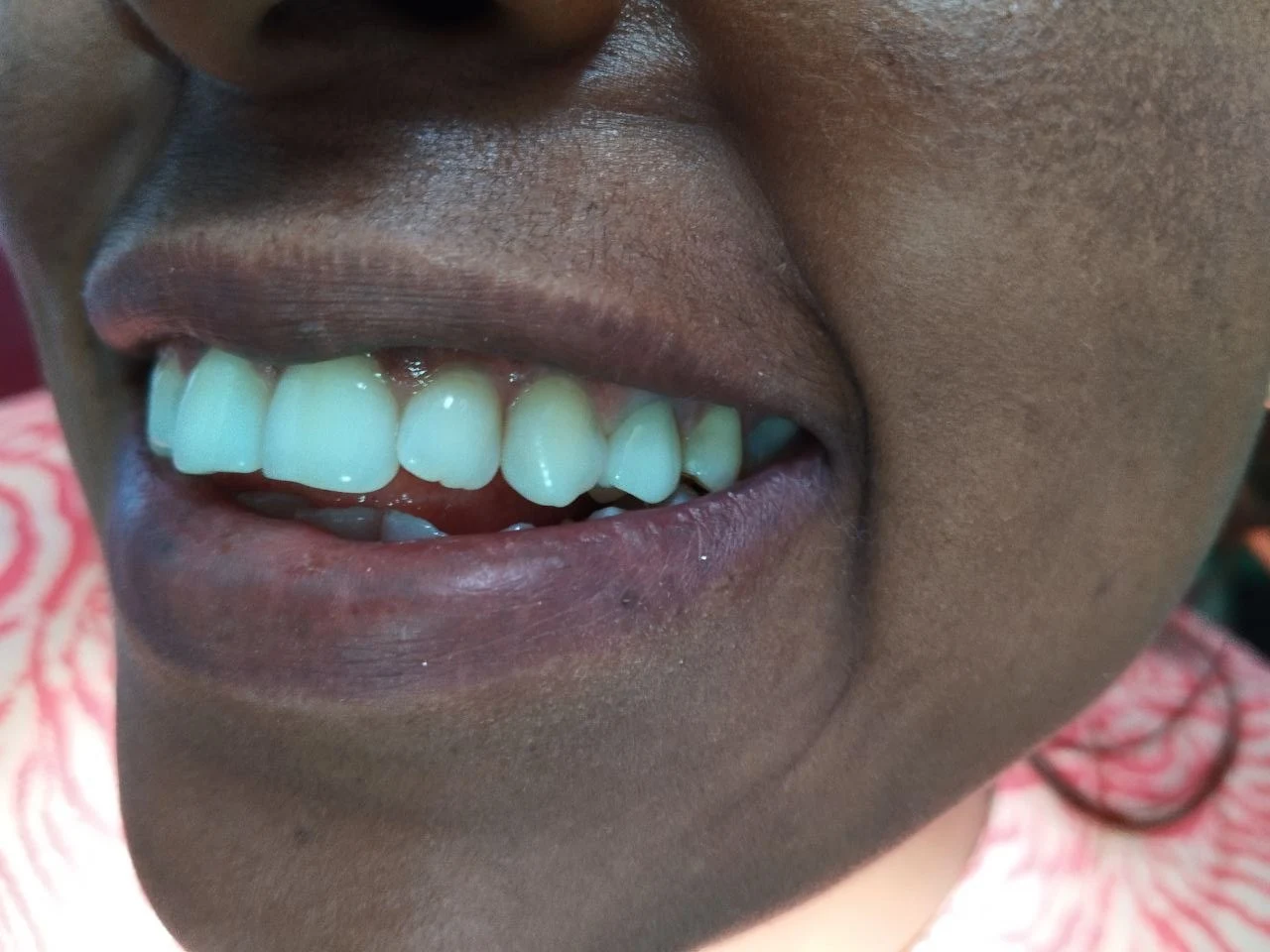 1-unit zirconia bridge, After