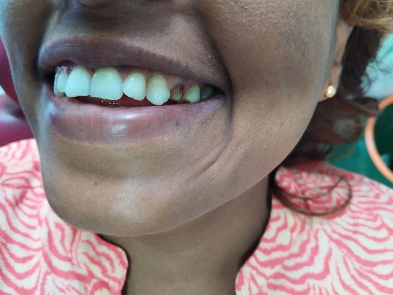 1-unit zirconia bridge, Before