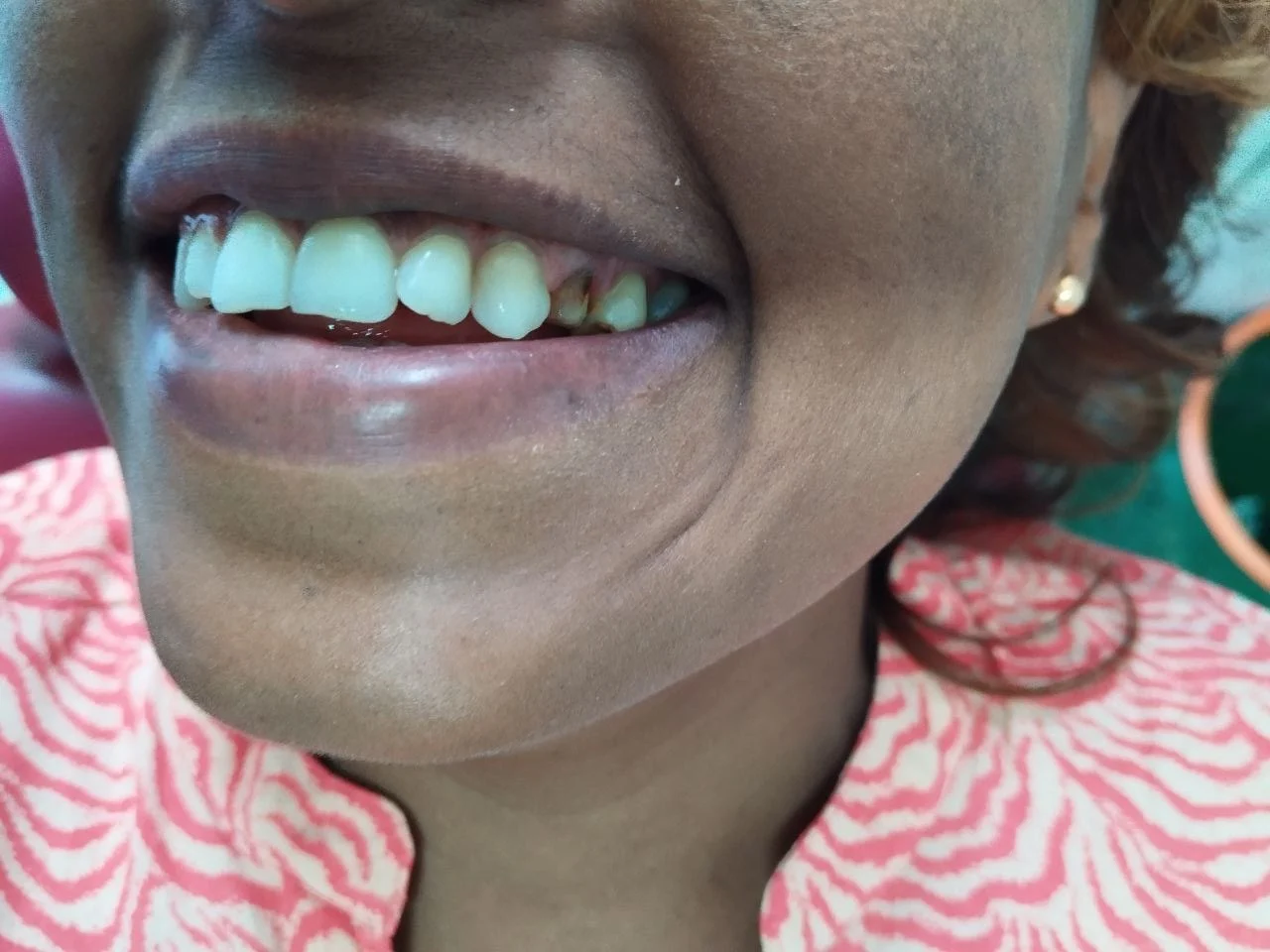 1-unit zirconia bridge, Before