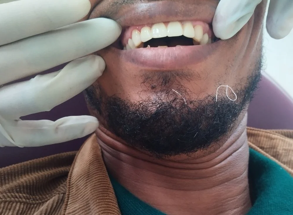 4-unit zirconia bridge, After