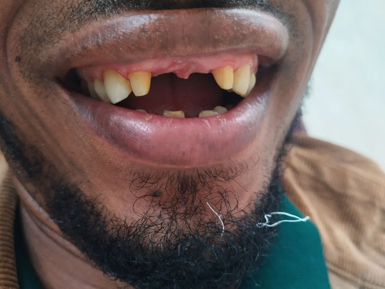 4-unit zirconia bridge, Before