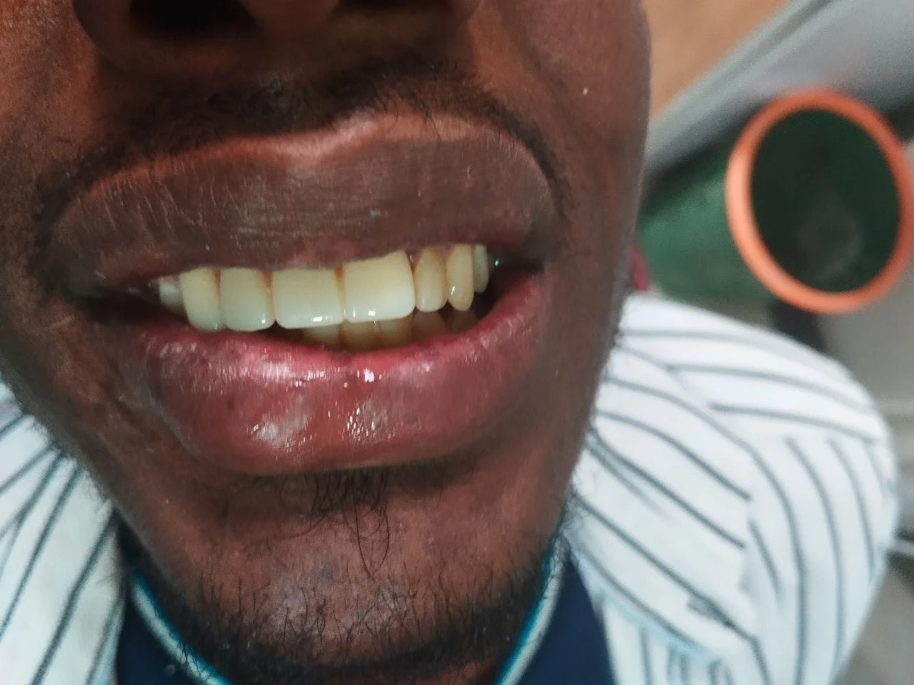 4-unit zirconia bridge, After