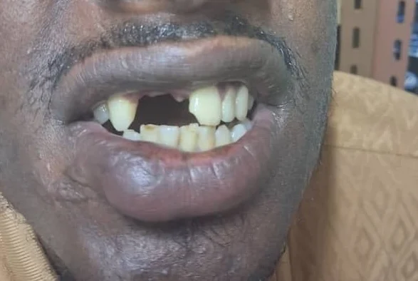 4-unit zirconia bridge, Before