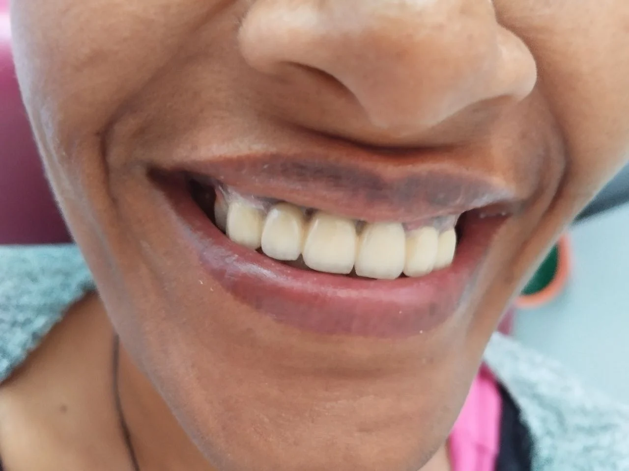 6-unit zirconia bridge, After