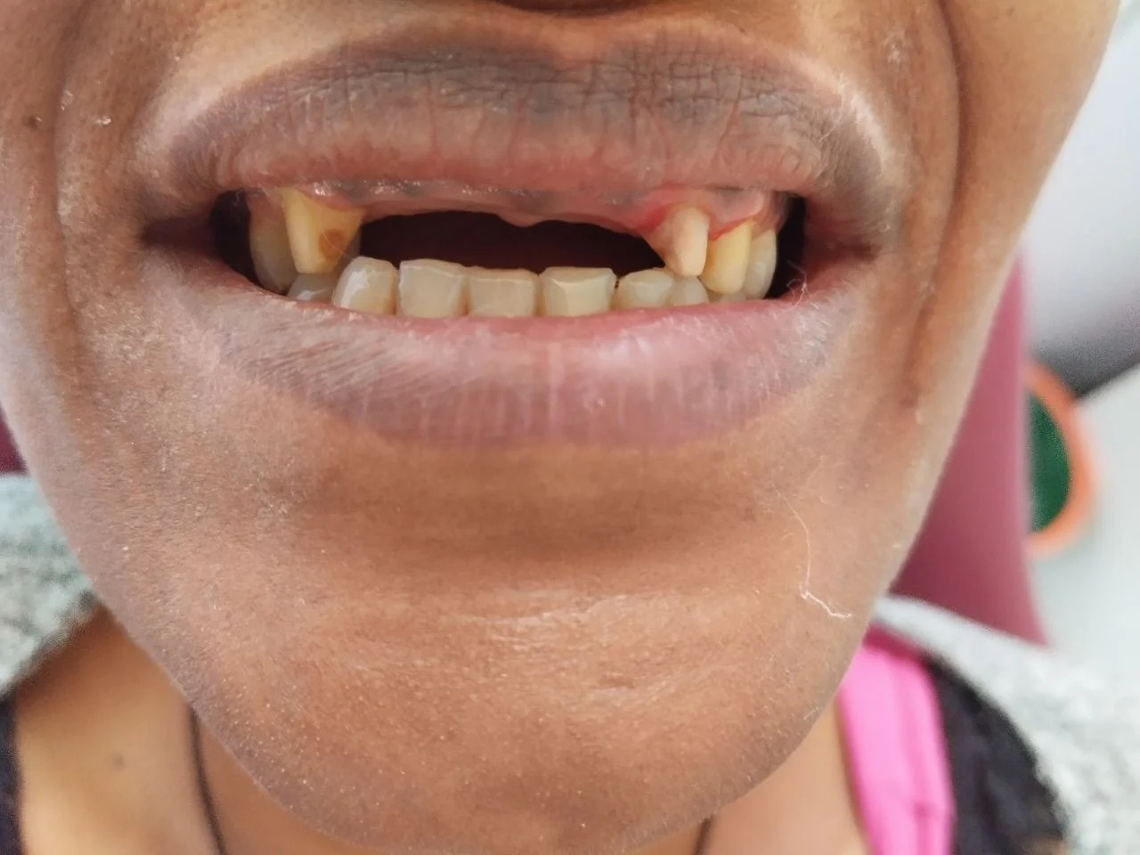 6-unit zirconia bridge, Before