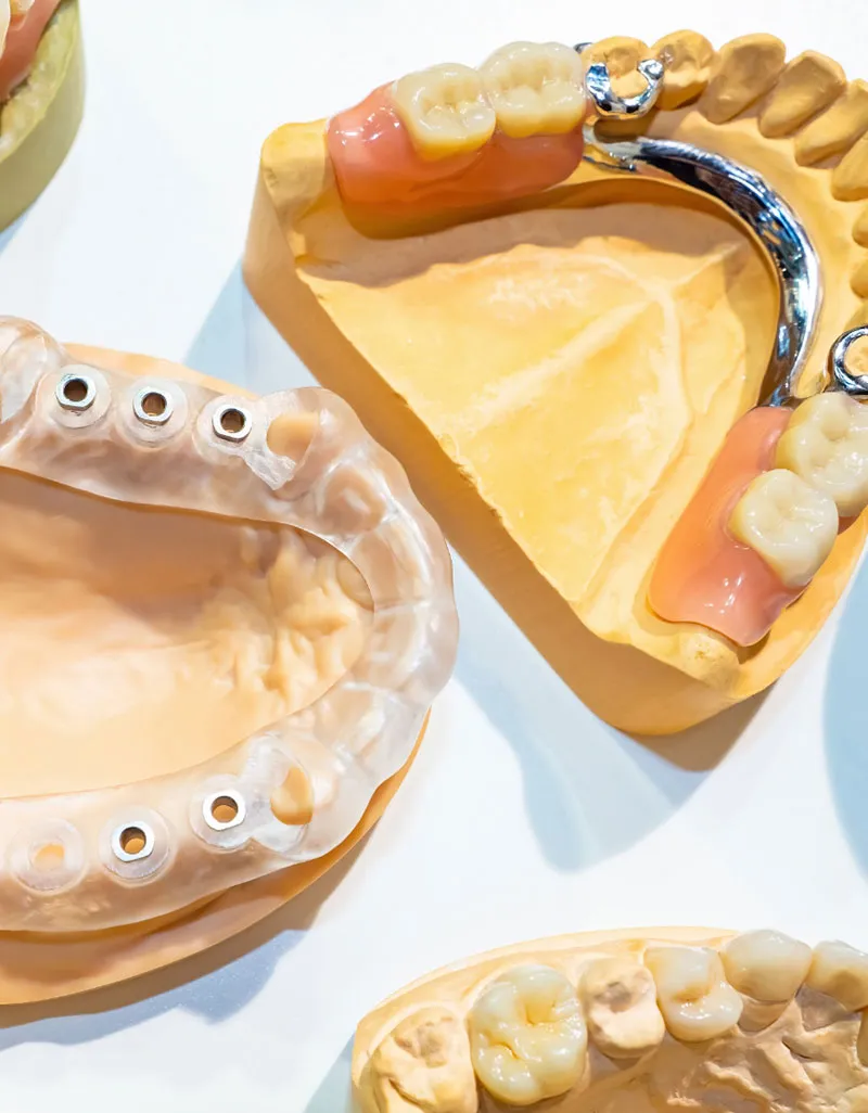 Dental Implants